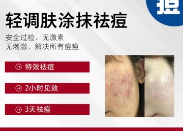 轻调肤涂抹祛痘